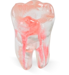 Endo 3DP™#30 Accessed Molar (LR6)