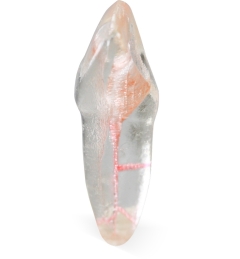 Endo 3DP™#09 Accessed Incisor (UL1)